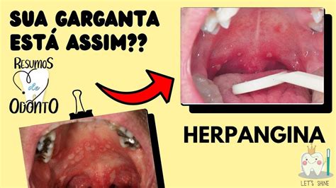 Herpangina | Resumos de Odonto - YouTube