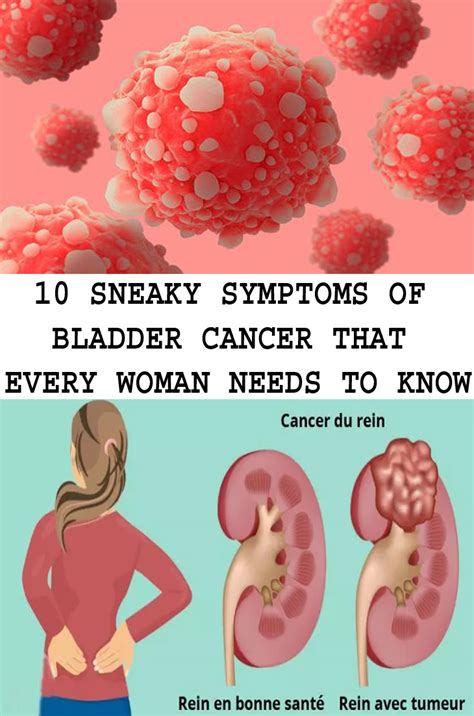 10 SNEAKY SYMPTOMS OF BLADDER CANCER THAT EVERY WOMAN NEEDS TO KNOW