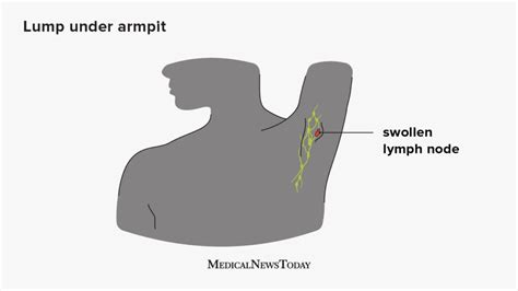 Swollen lymph nodes in armpit: Symptoms, causes, and treatment