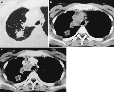 Pulmonary Tuberculosis | Radiology Key