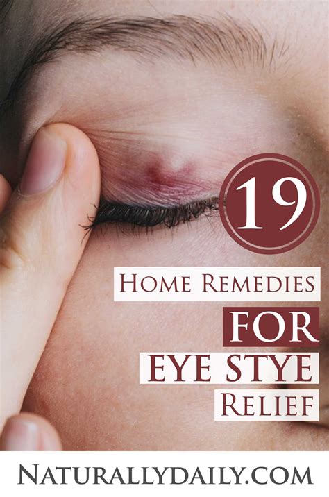 19 Home Remedies for Eye Stye Relief in 2020 (With images) | Sty in eye remedies, Eye stye ...