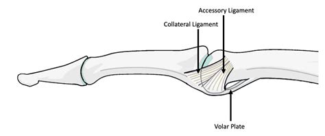 Volar Plate Injuries (Jammed Finger) Proximal Phalangeal Joint fractures – The Lothian Hand Unit