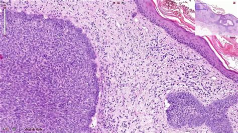 Basal Cell Carcinoma Including Variants - Histopathology - YouTube