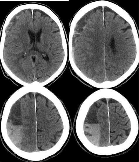 acute on chronic subdural hematoma