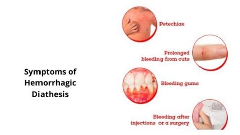 Hemorrhagic Diathesis: Causes, Symptoms and Treatment