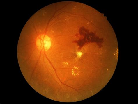 Moderate Nonproliferative Diabetic Retinopathy