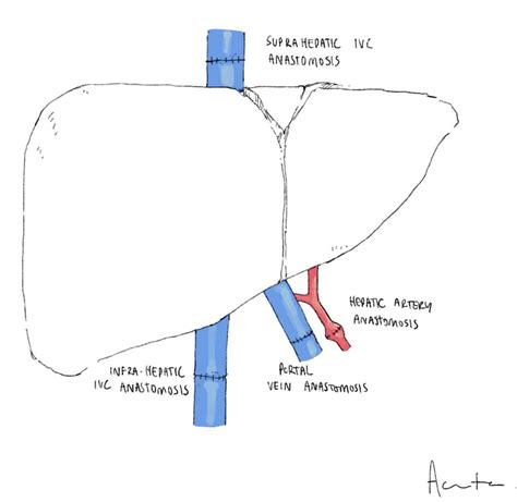 Liver Transplantation - TeachMeSurgery