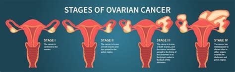 Premium Vector | Woman reproductive system with ovarian cancer stages