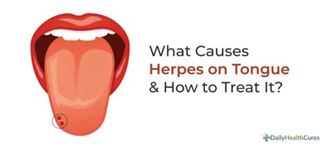 Herpes on Tongue: Symptoms, Causes, Stages & Treatment Options