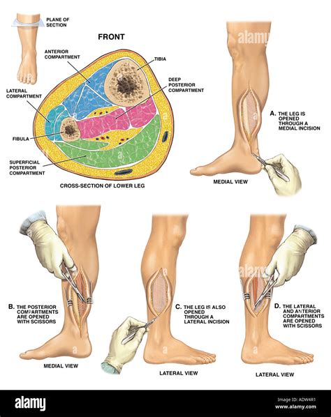 Compartment Syndrome with Four Compartment Fasciotomy Procedure Stock ...