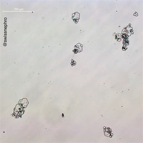 Urine Sediment of the Month: Cystine Crystals - Renal Fellow Network