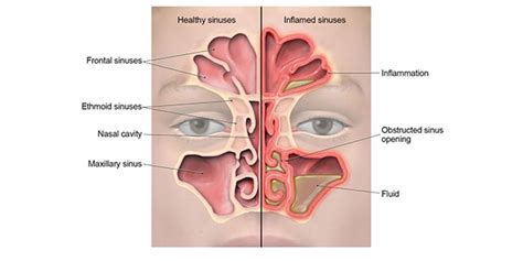 Sinus Infection (Sinusitis) | Antibiotic Use | CDC