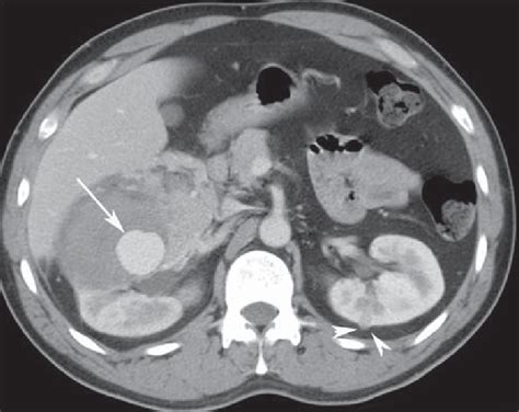 A 38-year-old man with tuberous sclerosis complex and renal lipid-poor ...