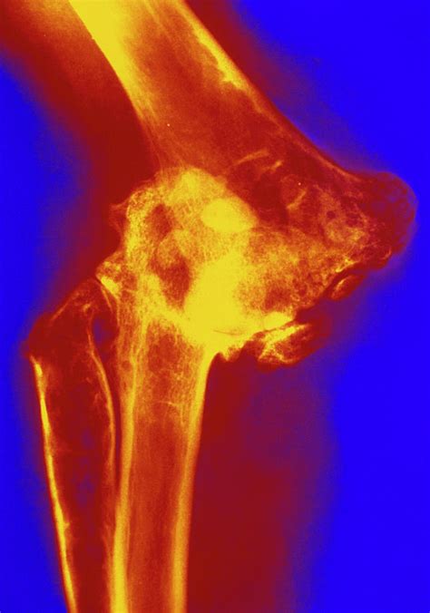 Col X-ray Of Rheumatoid Arthritis Of The Elbow Photograph by Medical ...