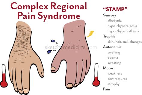 Pin on Complex Regional Pain Syndrome Type 1