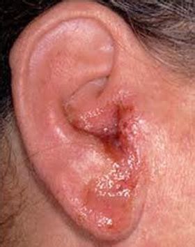 Outer Ear Infection - Symptoms, Treatment, Home Remedies, Pictures