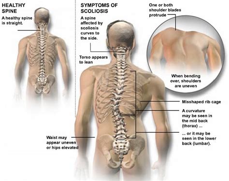 Signs of Scoliosis: What to Look For | Scoliosis SOS