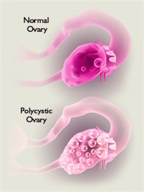 CAN OVARIAN CYSTS CONTRIBUTE TO INFERTILITY?: Rocky Mountain Fertility Center: Reproductive ...