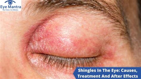 Shingles In The Eye: Causes, Treatment And After Effects