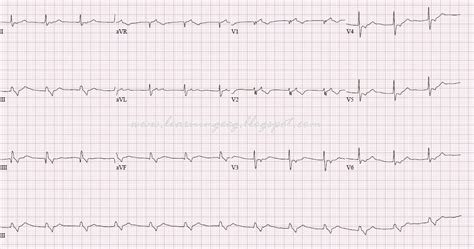 ECG Rhythms: Accelerated Junctional Rhythm