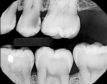 INTERPROXIMAL DECAY - Wake Dental Wellness : Dentist in Wake Forest