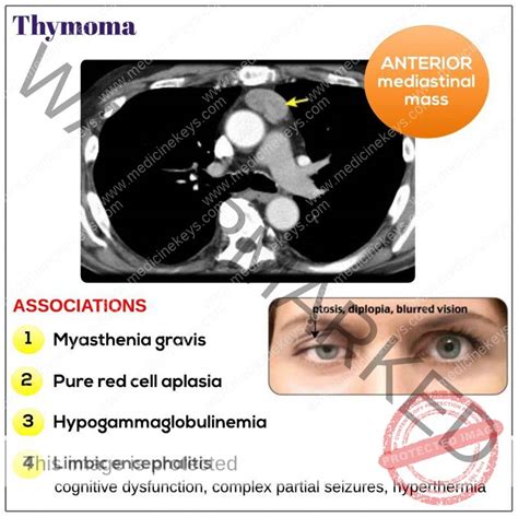 Thymoma - Medicine Keys for MRCPs