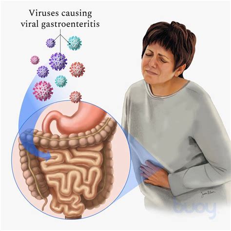 Viral Gastroenteritis Symptoms - Ask The Nurse Expert