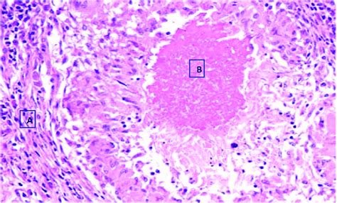 Tuberculosis Lymph Node Histology