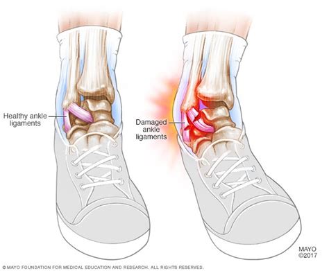 Sprained ankle Disease Reference Guide - Drugs.com