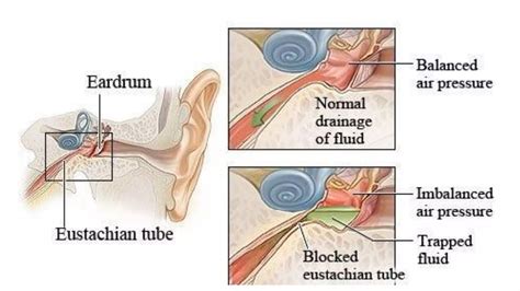 Ear barotrauma causes, symptoms and treatment | PPT