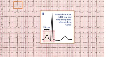 Short PR-interval and normal QRS-complex | Cardiocases