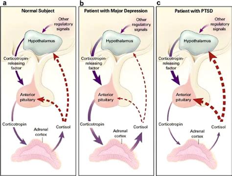 Response to stress in a normal subject (Panel A), a patient with MDD... | Download Scientific ...