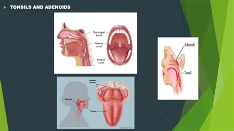 SOLUTION: Management of upper airway obstruction adenotonsillar ...