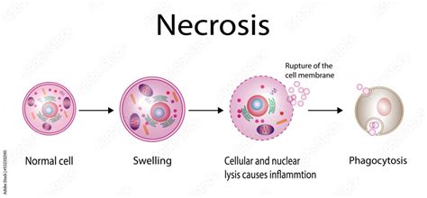 Necrosis, Pathologic Cell Death, Death of the body tissues, Cell injury which results in the ...