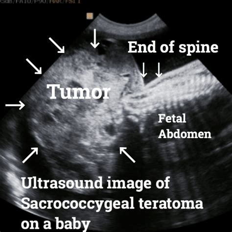 Teratoma. Causes, symptoms, diagnosis and treatment. - Ultrasoundfeminsider