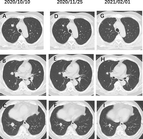 Frontiers | Metastatic Urachal Carcinoma Treated With Several Different Combined Regimens: A ...