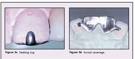 [PDF] Resin-retained Bridges Re-visited Part 2. Clinical Considerations | Semantic Scholar