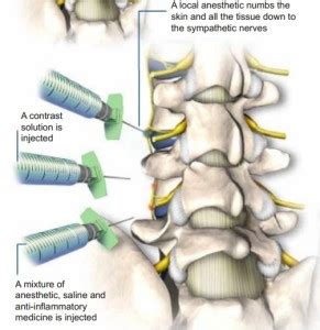 Lumbar Sympathetic Block - Dr. Michael A. Castillo, MD