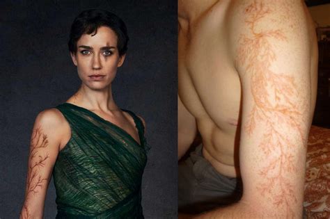 These Lightning Scars Explain What The Natural Disaster Does To Your Skin