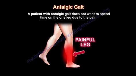 Antalgic Gait - Everything You Need To Know - Dr. Nabil Ebraheim - YouTube