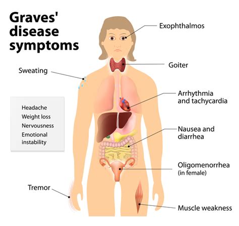 Graves' Disease Symptoms | oneGRAVESvoice