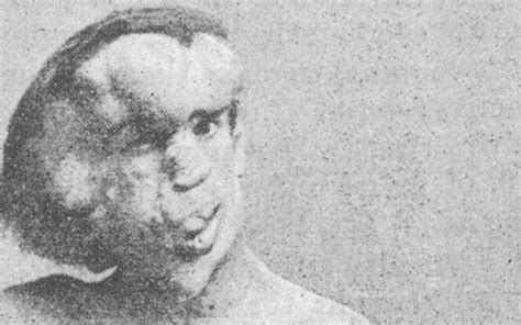 Podcast : Joseph Merrick, ou la véritable histoire d'Elephant Man