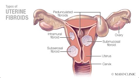 Mayo Clinic Minute: Treatment for uterine fibroids without surgery - Mayo Clinic News Network