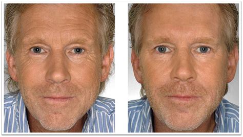 Injectables Before & After Pictures - Injector 5280