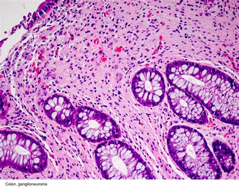 Pathology Outlines - Ganglioneuroma