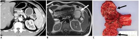 40-year-old man with cystic change of islet cell tumor manifesting as ...