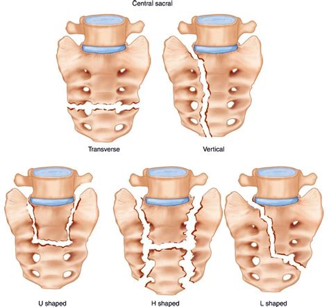 Sacral Fracture