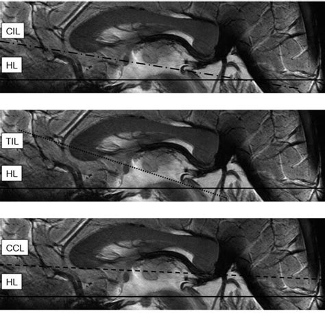 (PDF) Anterior Commissure - Posterior Commissure Revisited