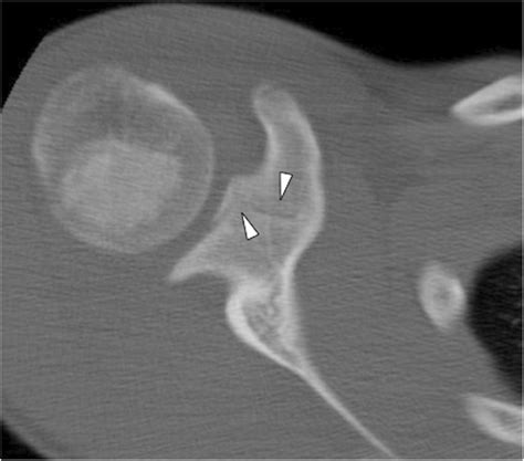 Acute coracoid injury in a 13-year-old boy with a scapular fracture.... | Download Scientific ...