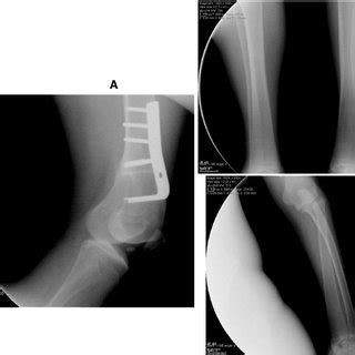 X-ray at the age of 16 years. A) Coxa valga requested surgical... | Download Scientific Diagram